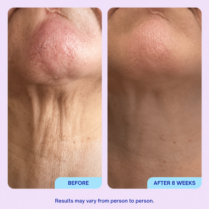 Last Day Buy 1 Get 1 Free✨Mirevyn💧Advanced Neck Firming Cream – Lift, Tighten & Restore Youthful-Looking Skin